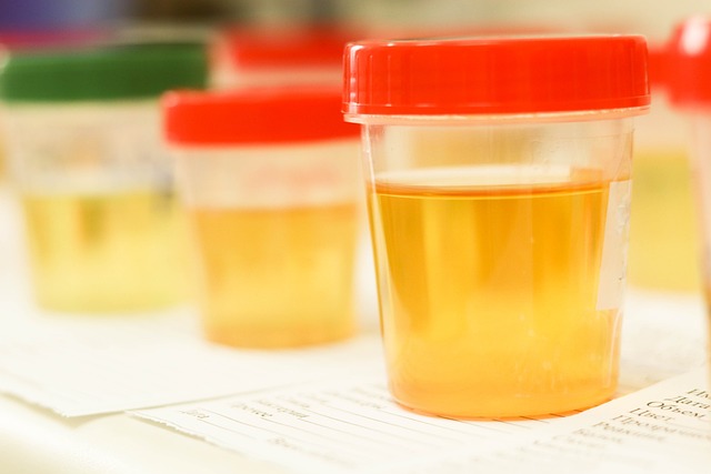 Posiew moczu – co to jest badanie mikrobiologiczne moczu i kiedy je wykonywać?
